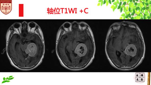 【病例】脑室内脑膜瘤1例MR影像表现 【病例】脑室内脑膜瘤1例MR影像表现