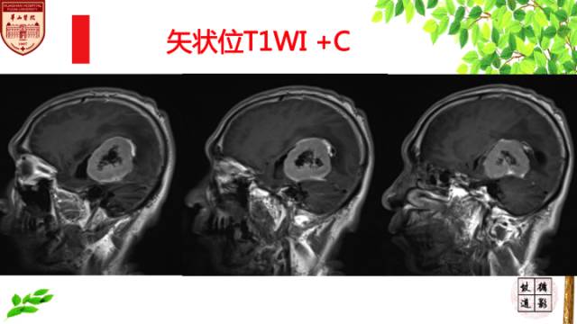 【病例】脑室内脑膜瘤1例MR影像表现 【病例】脑室内脑膜瘤1例MR影像表现
