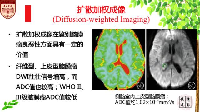 【病例】脑室内脑膜瘤1例MR影像表现 【病例】脑室内脑膜瘤1例MR影像表现
