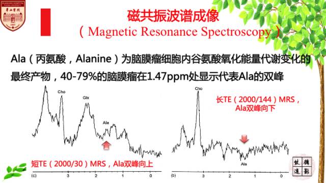 【病例】脑室内脑膜瘤1例MR影像表现 【病例】脑室内脑膜瘤1例MR影像表现