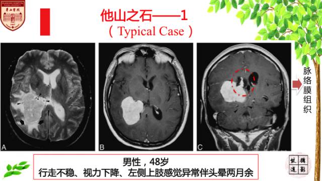 【病例】脑室内脑膜瘤1例MR影像表现 【病例】脑室内脑膜瘤1例MR影像表现