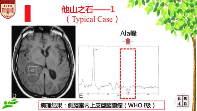 【病例】脑室内脑膜瘤1例MR影像表现 【病例】脑室内脑膜瘤1例MR影像表现