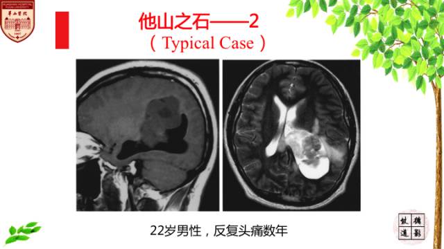 【病例】脑室内脑膜瘤1例MR影像表现 【病例】脑室内脑膜瘤1例MR影像表现