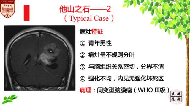 【病例】脑室内脑膜瘤1例MR影像表现 【病例】脑室内脑膜瘤1例MR影像表现