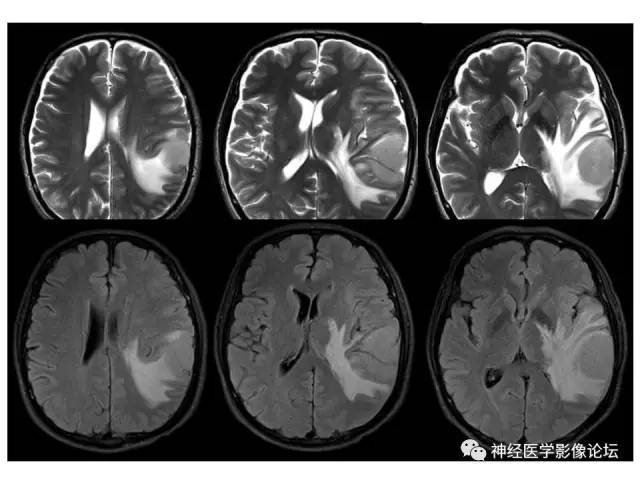 【病例】伴有脑膜尾征的3例颅内肿瘤影像鉴别讨论