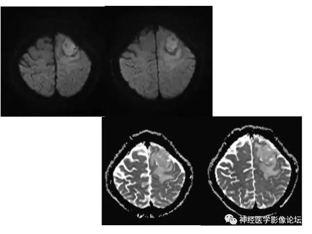 【病例】伴有脑膜尾征的3例颅内肿瘤影像鉴别讨论