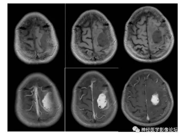 【病例】伴有脑膜尾征的3例颅内肿瘤影像鉴别讨论
