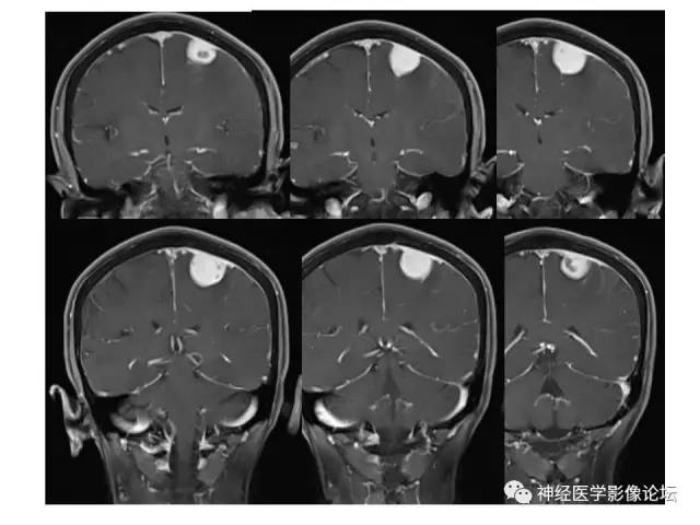 【病例】伴有脑膜尾征的3例颅内肿瘤影像鉴别讨论