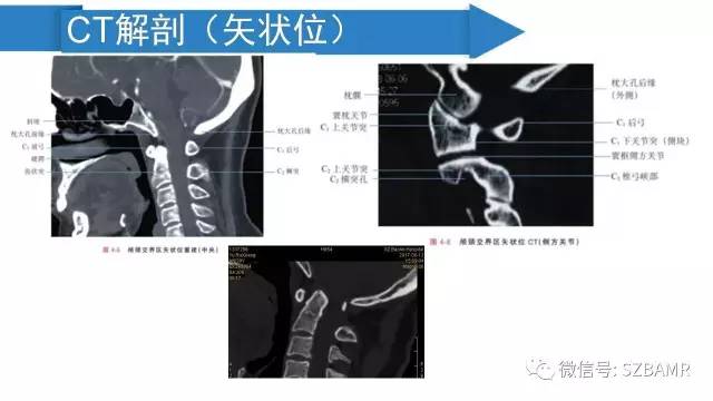 【PPT】颅底交界区畸形影像诊断
