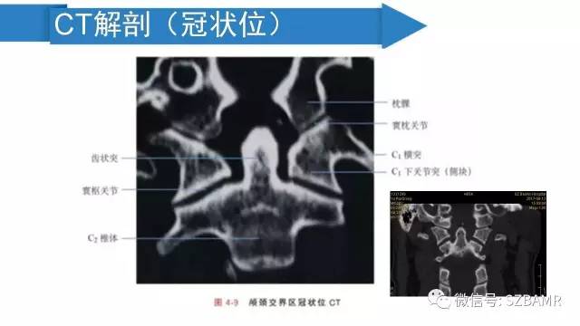 【PPT】颅底交界区畸形影像诊断