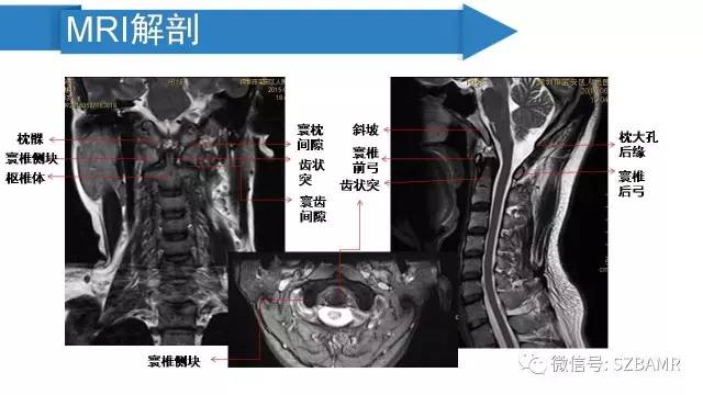 【PPT】颅底交界区畸形影像诊断