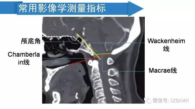 【PPT】颅底交界区畸形影像诊断