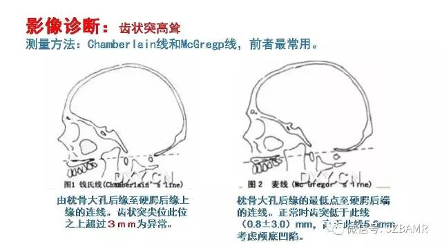 【PPT】颅底交界区畸形影像诊断