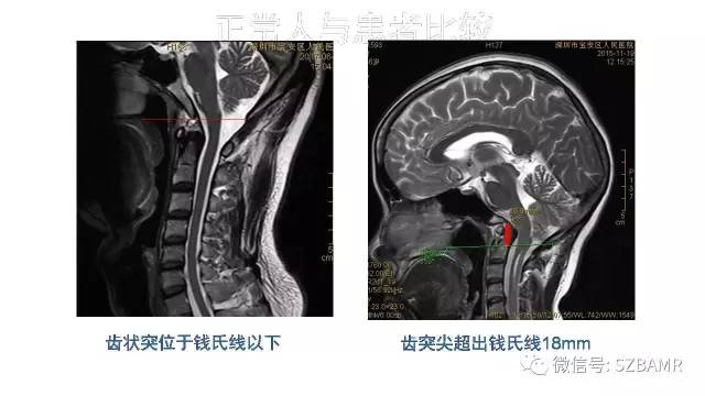 【PPT】颅底交界区畸形影像诊断