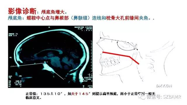 【PPT】颅底交界区畸形影像诊断