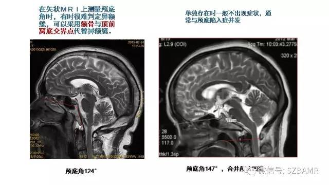 【PPT】颅底交界区畸形影像诊断