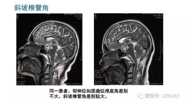 【PPT】颅底交界区畸形影像诊断