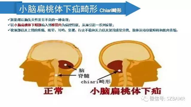 【PPT】颅底交界区畸形影像诊断