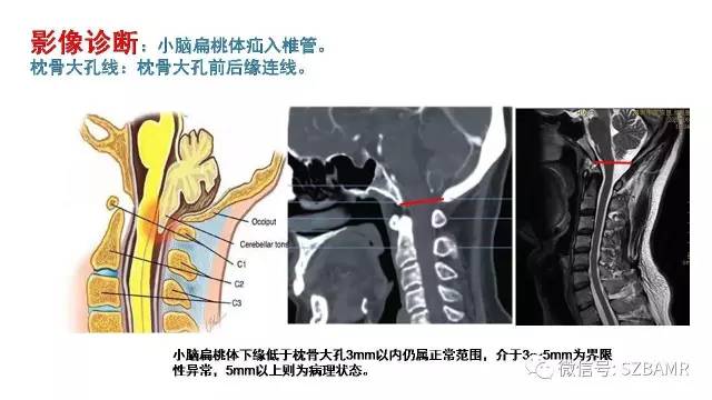 【PPT】颅底交界区畸形影像诊断