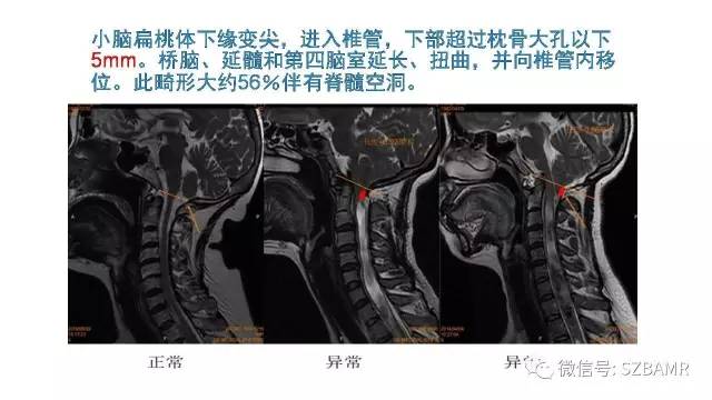 【PPT】颅底交界区畸形影像诊断