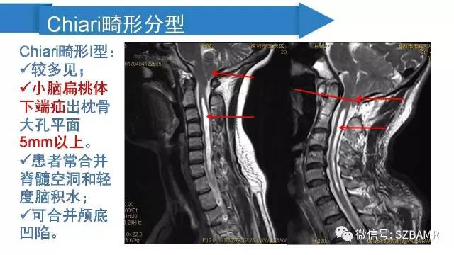 【PPT】颅底交界区畸形影像诊断
