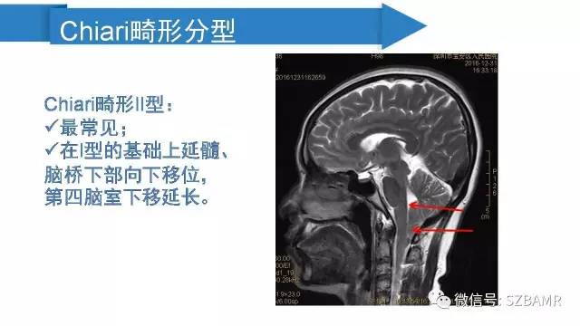 【PPT】颅底交界区畸形影像诊断