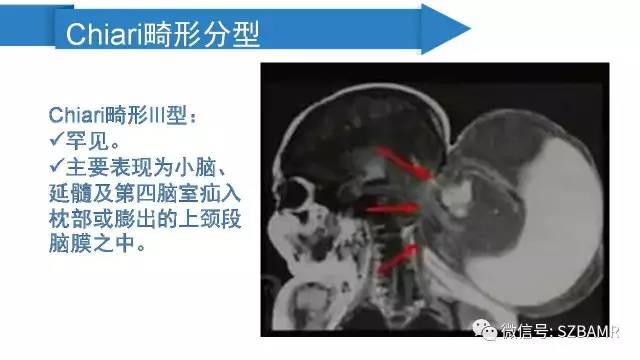 【PPT】颅底交界区畸形影像诊断