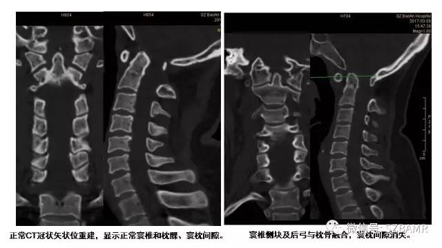 【PPT】颅底交界区畸形影像诊断