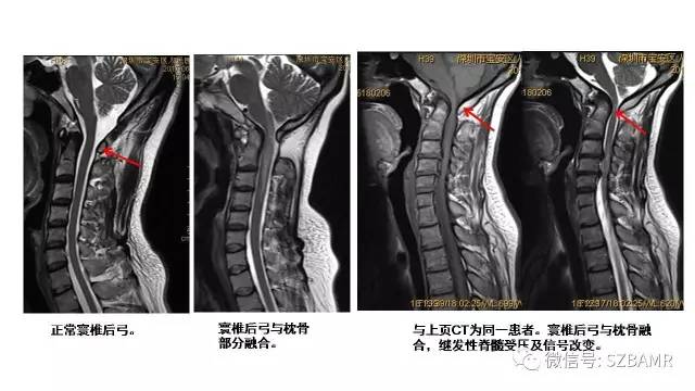 【PPT】颅底交界区畸形影像诊断