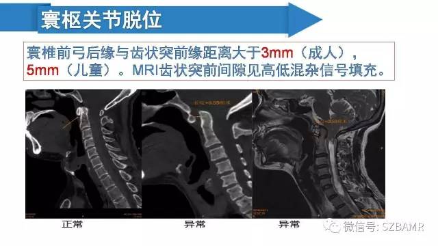 【PPT】颅底交界区畸形影像诊断