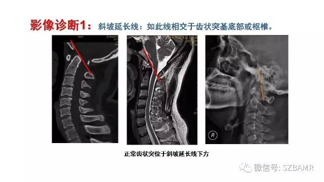 【PPT】颅底交界区畸形影像诊断
