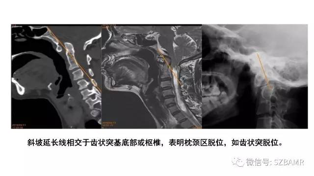 【PPT】颅底交界区畸形影像诊断