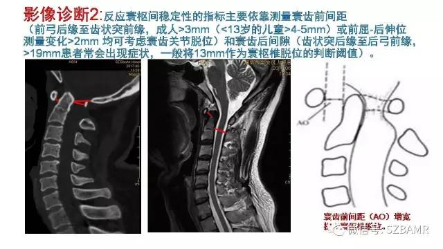 【PPT】颅底交界区畸形影像诊断