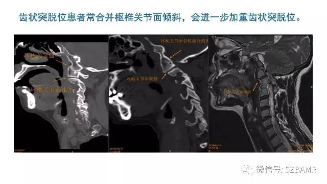 【PPT】颅底交界区畸形影像诊断