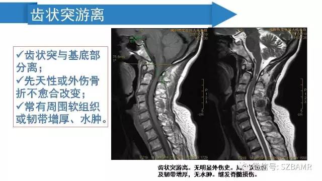 【PPT】颅底交界区畸形影像诊断