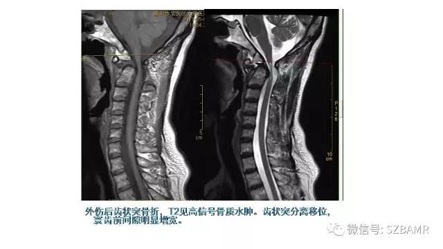 【PPT】颅底交界区畸形影像诊断