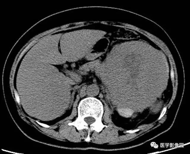 【病例】腹膜后平滑肌肉瘤1例CT影像表现