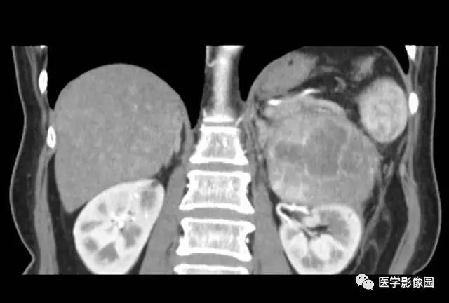 【病例】腹膜后平滑肌肉瘤1例CT影像表现