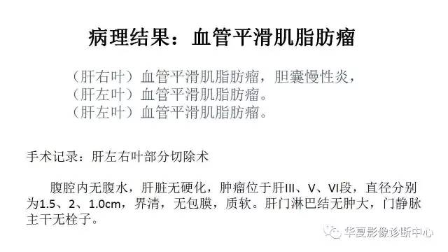 【病例】肝内多发血管平滑肌脂肪瘤1例CT及MR