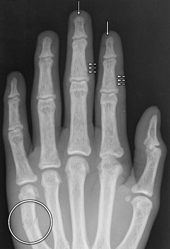 代谢性骨病的影像学表现：甲状旁腺功能亢进Hyperparathyroidism