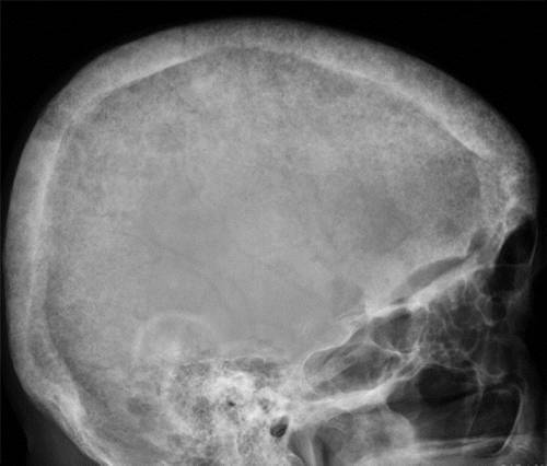 代谢性骨病的影像学表现:甲状旁腺功能亢进Hyperparathyroidism 代谢性骨病的影像学表现:甲状旁腺功能亢进Hyperparathyroidism