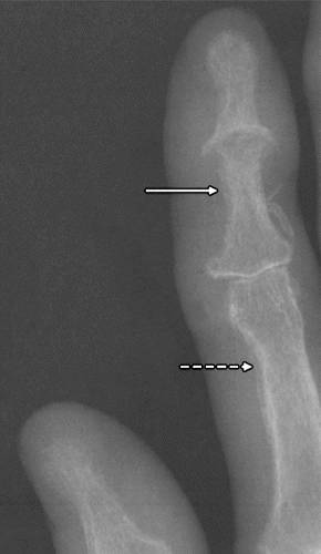 代谢性骨病的影像学表现:甲状旁腺功能亢进Hyperparathyroidism 代谢性骨病的影像学表现:甲状旁腺功能亢进Hyperparathyroidism
