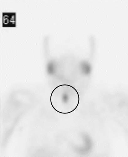 代谢性骨病的影像学表现:甲状旁腺功能亢进Hyperparathyroidism 代谢性骨病的影像学表现:甲状旁腺功能亢进Hyperparathyroidism