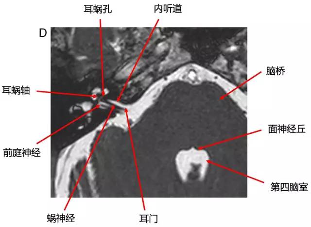 桥小脑角区正常影像解剖及常见病变 桥小脑角区正常影像解剖及常见病变