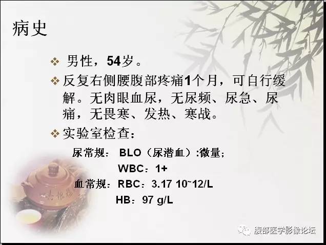 【病例】右肾骨外骨肉瘤1例CT