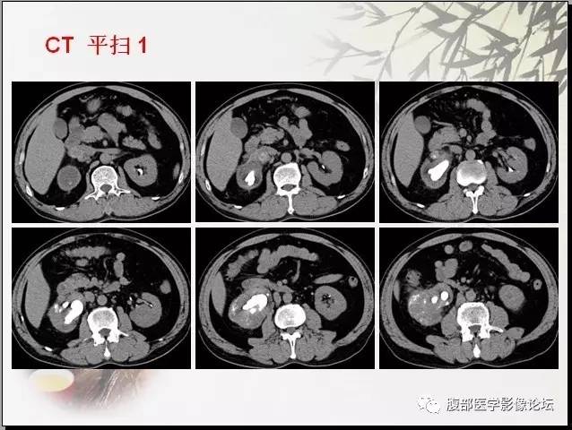 【病例】右肾骨外骨肉瘤1例CT 【病例】右肾骨外骨肉瘤1例CT