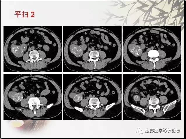【病例】右肾骨外骨肉瘤1例CT 【病例】右肾骨外骨肉瘤1例CT