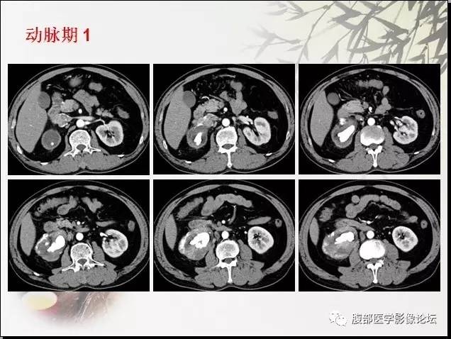 【病例】右肾骨外骨肉瘤1例CT 【病例】右肾骨外骨肉瘤1例CT