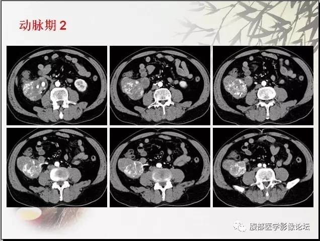 【病例】右肾骨外骨肉瘤1例CT 【病例】右肾骨外骨肉瘤1例CT