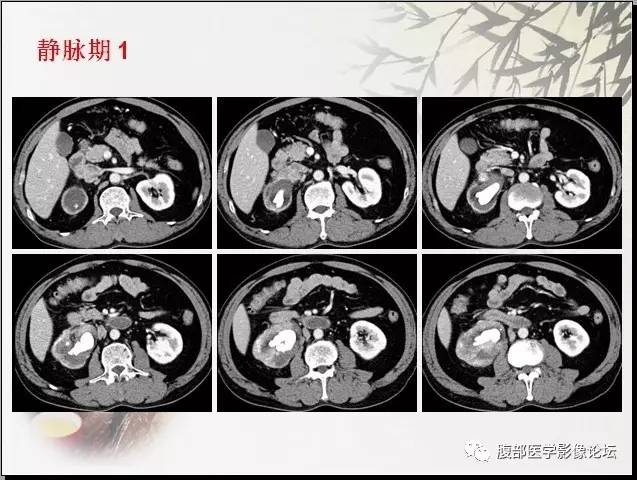 【病例】右肾骨外骨肉瘤1例CT 【病例】右肾骨外骨肉瘤1例CT